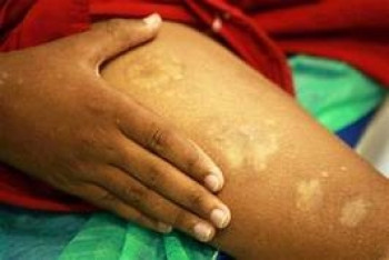 Ju�na foi a 3� cidade de MT com maior n�mero de casos de hansen�ase em 2019